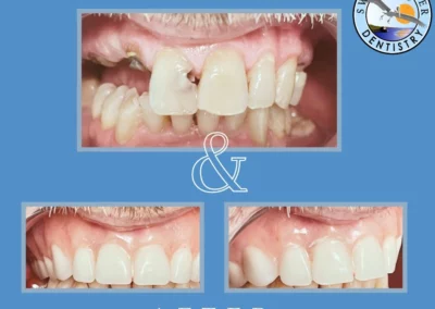 Smile transformation showing before and after treatment