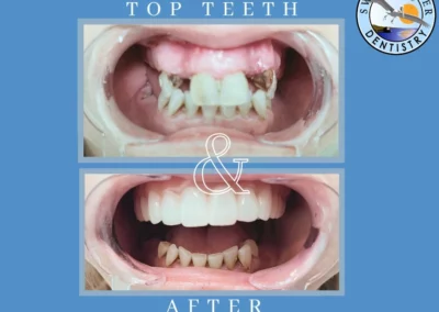 Smile transformation showing before and after treatment