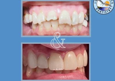 Smile transformation showing before and after treatment