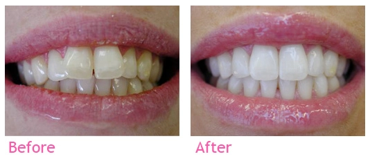 Invisalign smile transformation showing before and after treatment