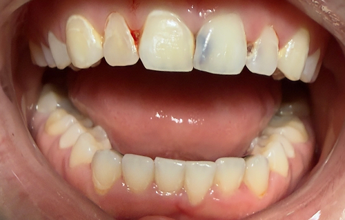 Patient smile before treatment