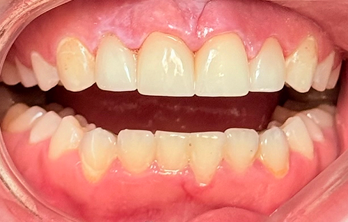 Patient smile after treatment