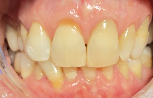 Patient smile before treatment
