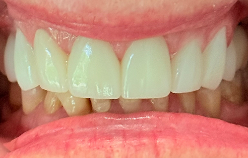 Patient smile after treatment