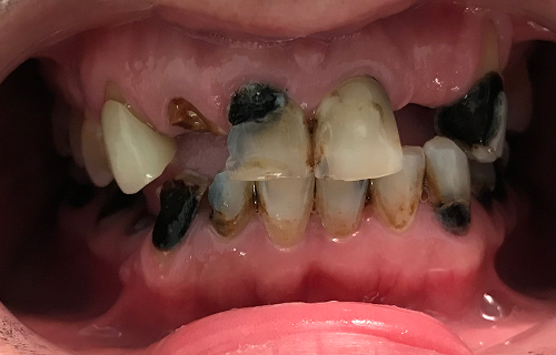 Patient smile before treatment