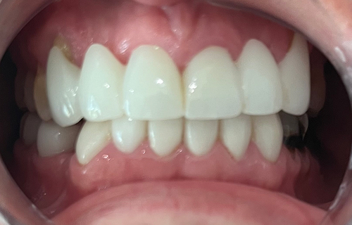 Patient smile after treatment