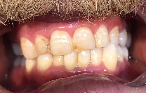 Patient smile before treatment
