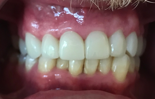 Patient smile after treatment