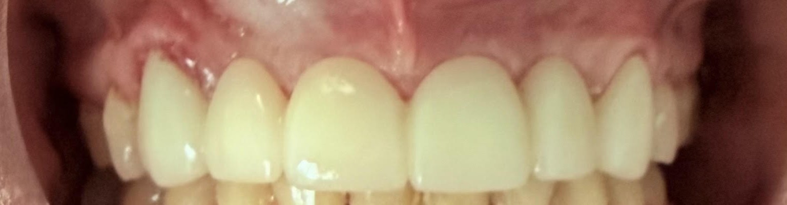 Patient smile after bridge treatment