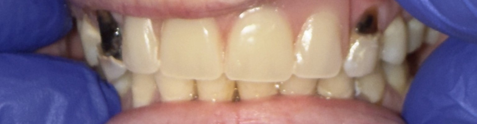 Patient smile before bridge treatment