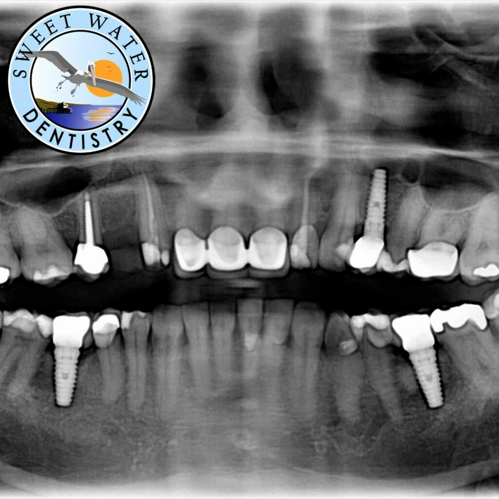 Sweet Water smile - Dental Implants