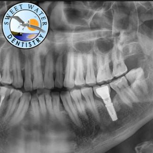 How Long Does The First Step Of A Dental Implant Take?