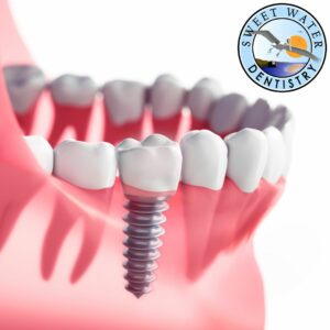 Replace All My Teeth with Dental Implants