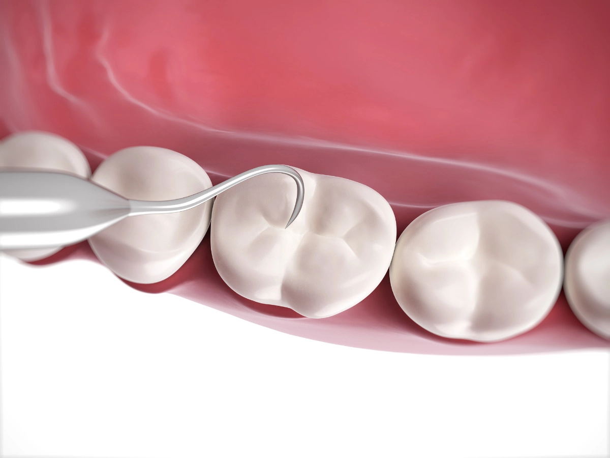 gum Debridement