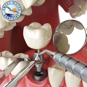 dental implant