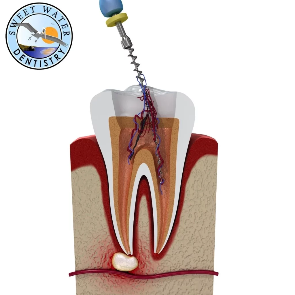 Fairhope root canal