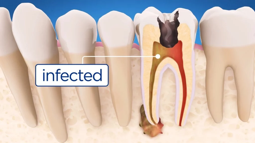 root-canal-treatment-step-by-ste