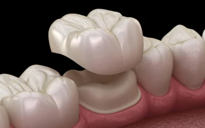 Dental Crown Procedure in Fairhope, AL: Step-by-Step Guide to Getting a Tooth Crown