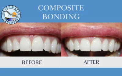 Dental Bonding in Fairhope, AL: Affordable Cosmetic Fix for Chips, Gaps, and Imperfections