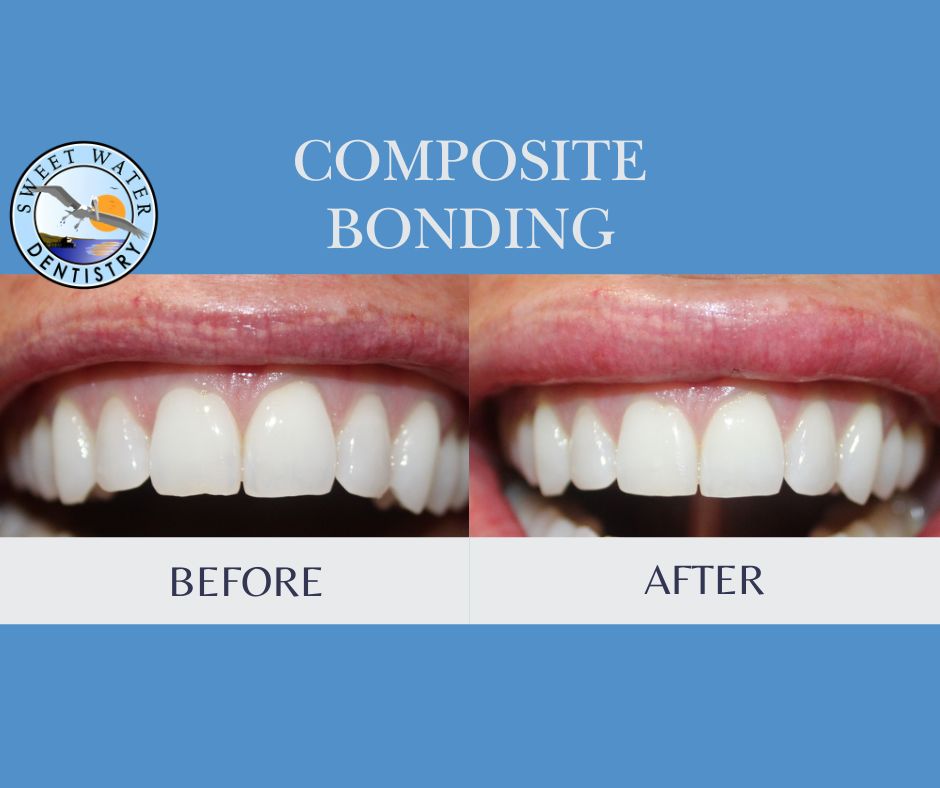 Sweet Water smile - dental bonding