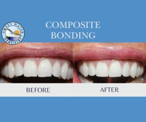 Composite Bonding Before & After