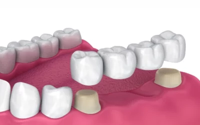 Can Dental Bridges Improve Your Smile? Cosmetic Benefits of Dental Bridges in Fairhope, AL