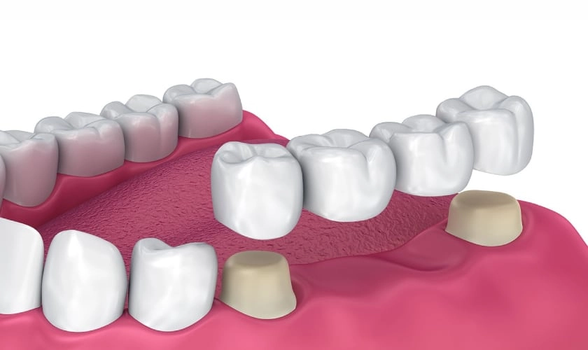 Bridge-Dentist-Fairhope-AL