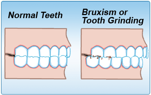 Bruxism or Teeth Grinding