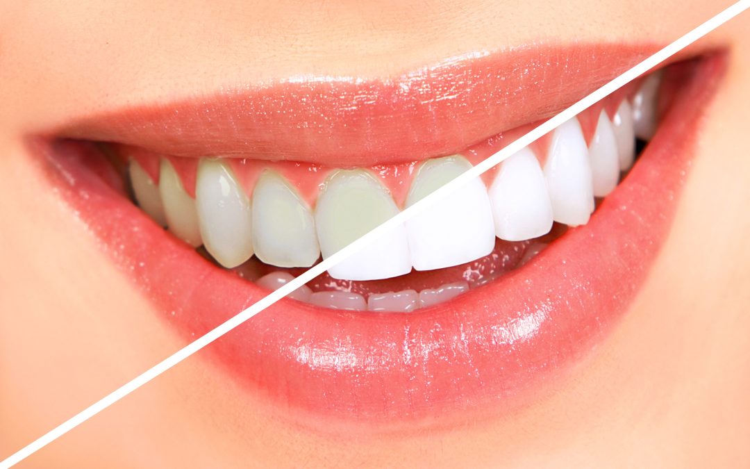 Can You Over Whiten your Teeth?