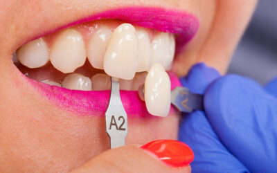 Cost of Veneers Dentist in Fairhope