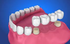 Sweet Water smile - Dental-Bridge