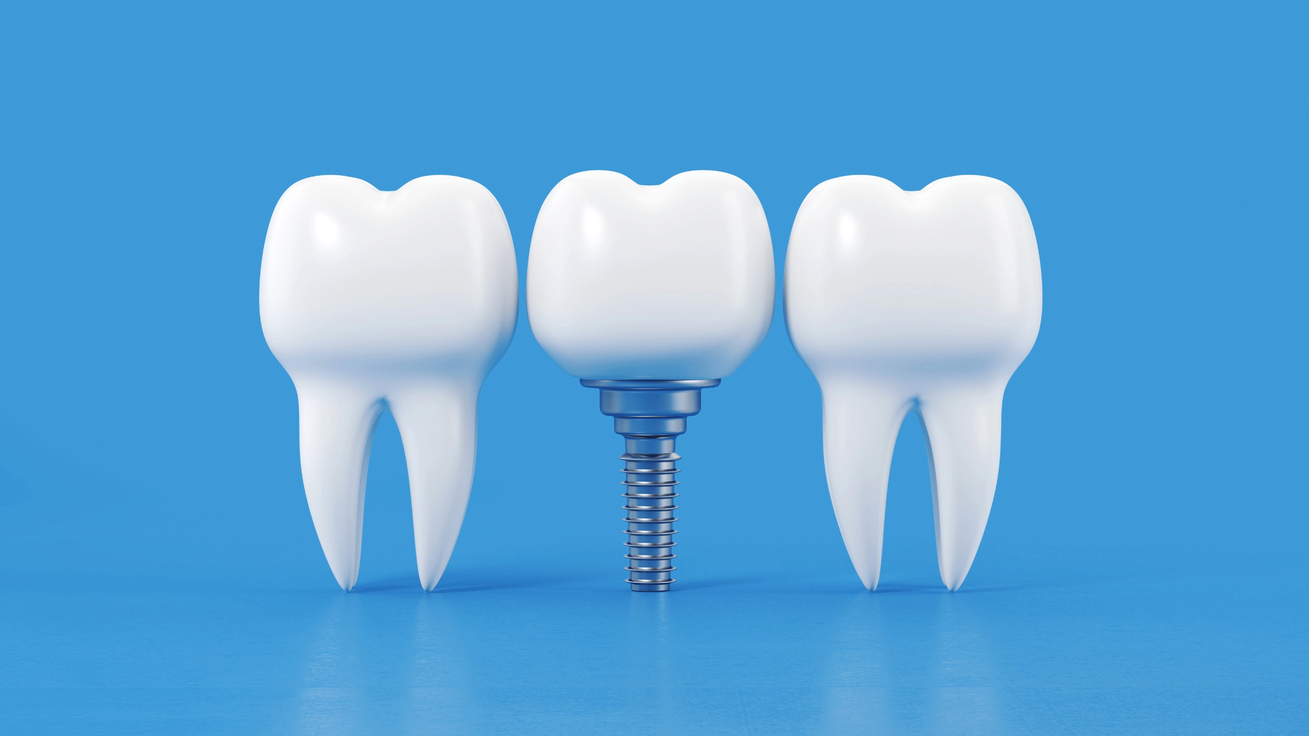 Dental Implants