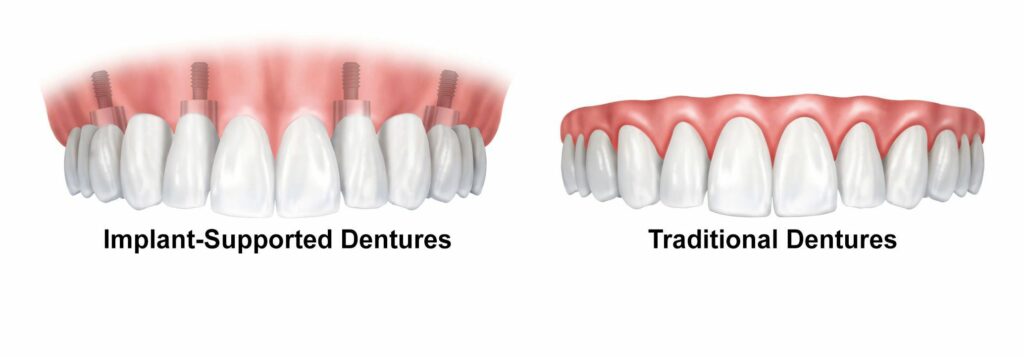 Dental Implants Dentures