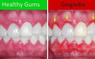 Fairhope, AL Dentistry All about Gingivitis
