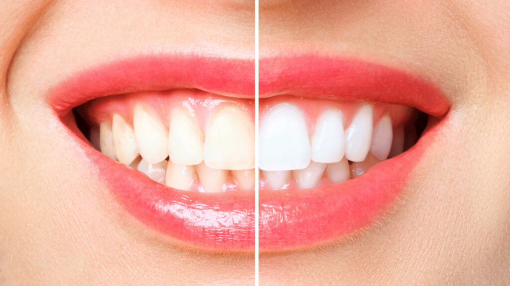 Teeth Whitening at Sweet Water Dentistry