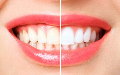 Teeth Whitening at Sweet Water Dentistry