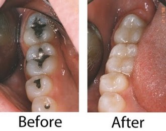 Tooth Filling in Fairhope AL