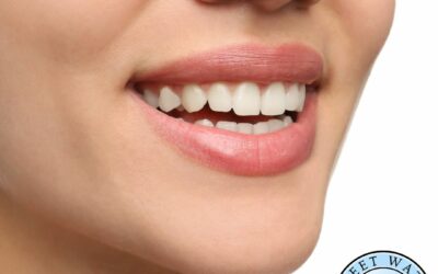 Cost of Porcelain Veneers in Fairhope, AL: What to Expect