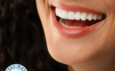 Porcelain Veneers in Fairhope, AL: The Ultimate Smile Makeover Solution