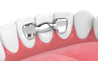 Dental Bridge for Front Teeth in Fairhope, AL: Restore Your Smile Naturally
