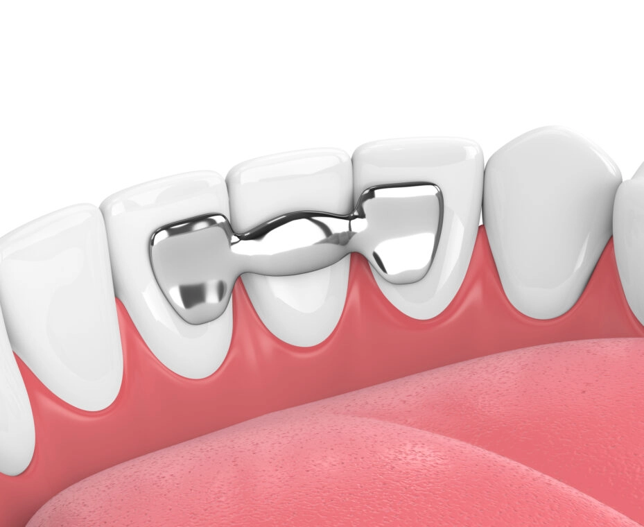 Sweet Water smile - bridge Fairhope dentist