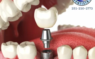 Dental Implants in Fairhope, AL | Implant Dentist FAQ Guide