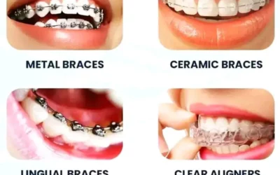 Different Options for Orthodontic Braces