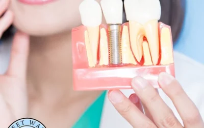 Are Dental Implants Worth It? A Complete Guide for Patients in Fairhope, AL