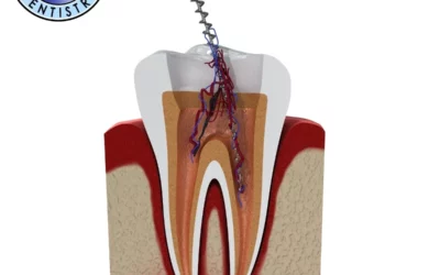 Do I Really Need a Root Canal? Myths vs. Facts for Fairhope, AL Patients