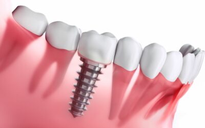 Dental Implants Fairhope AL