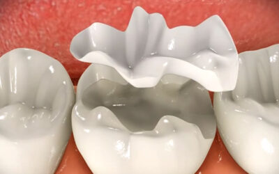 Cosmetic Dentistry Inlays And Onlays