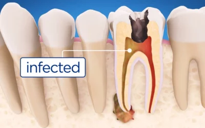 My Dentist Said I Need a Root Canal: What Is It, and Why Should I Get It Done?