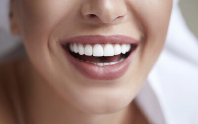 Dental Veneers Daphne AL