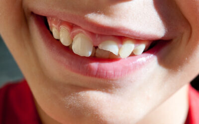 Chipped Tooth Dentist in Fairhope, AL